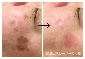 脂漏性角化症の治療 老人性イボの取り方 東京 大阪の美容皮膚科ならflalu フラルクリニック