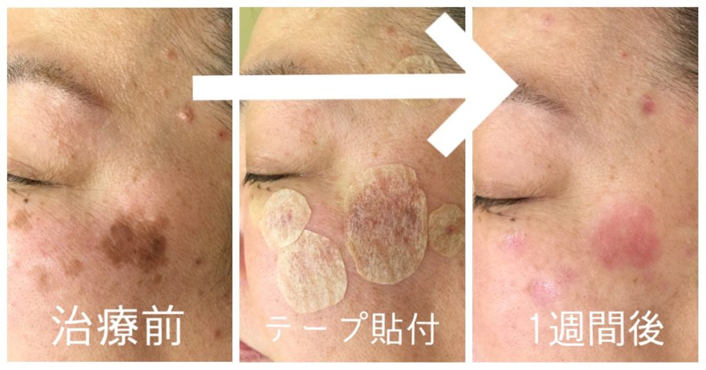 炭酸ガスレーザーでイボを除去 治療経過 東京 大阪の美容皮膚科ならflalu フラルクリニック
