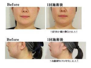 美容施術「テノール」のたるみ改善効果 - 東京・大阪の美容 …
