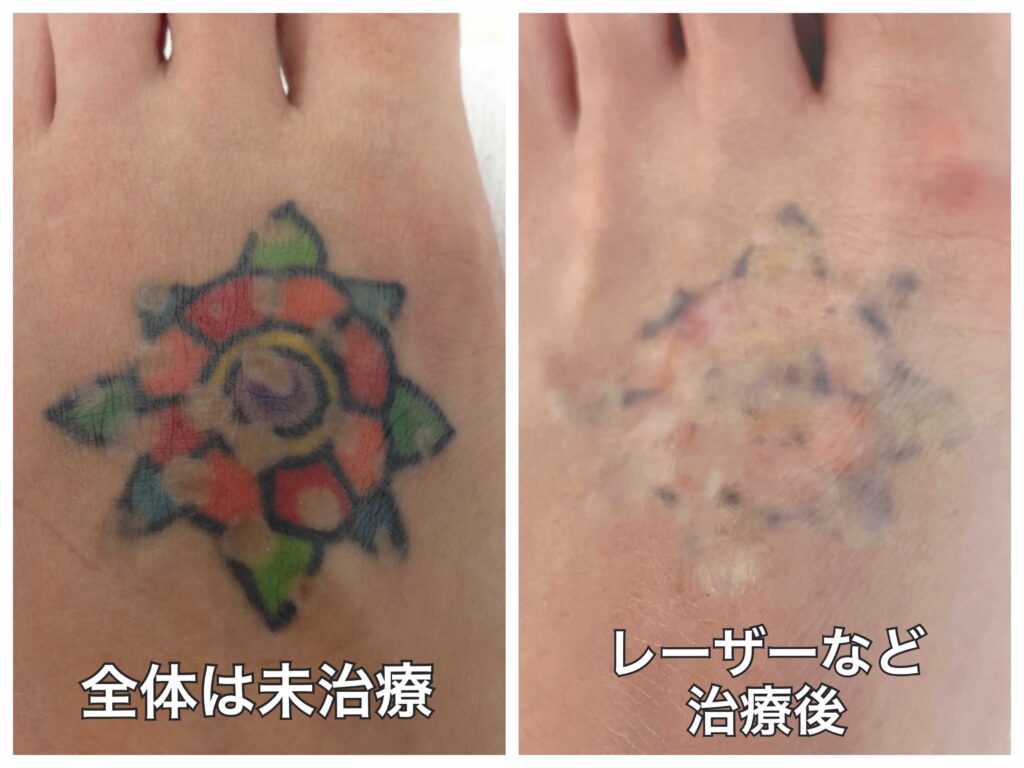 タトゥー除去の経過