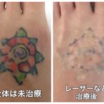 タトゥー除去の経過