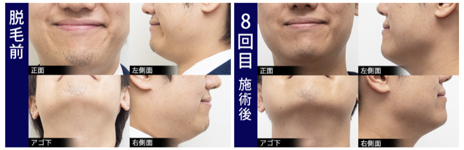 ヒゲ脱毛のビフォーアフター