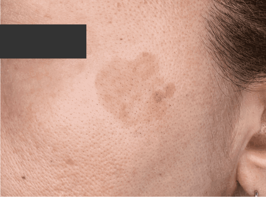 老人性色素斑の症例