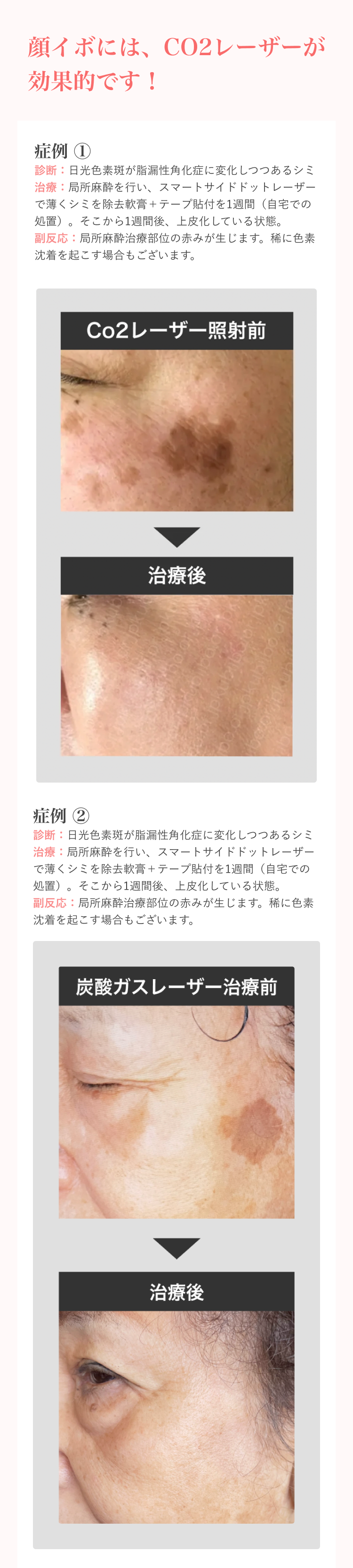 顔イボLP症例