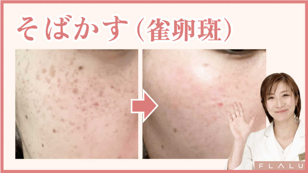 そばかす(雀卵斑)