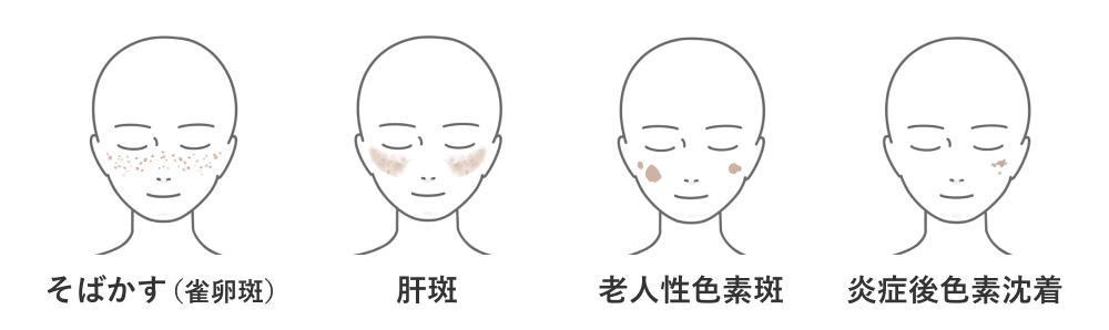 シミの種類1