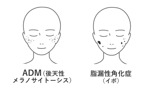 シミの種類2