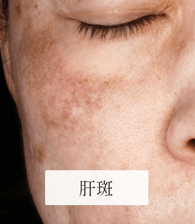 13_個別症例_肝斑