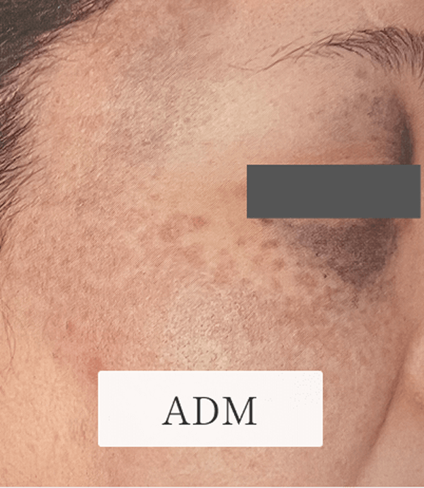 11_個別症例_ADM 1