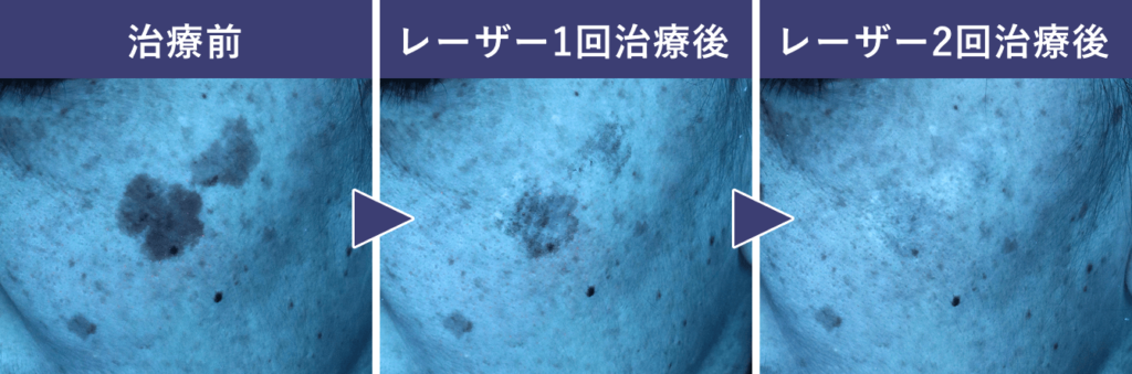 シミ取りレーザーの失敗例(失敗パターン1. シミは薄くなったけれど、完全に取れていない)