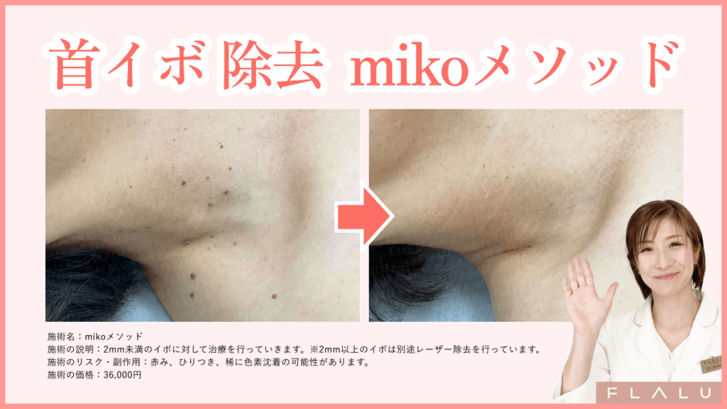 首イボ除去_MV_260203