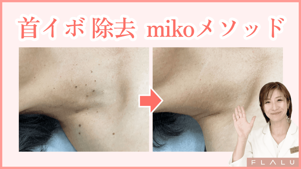首イボ治療のmikoメソッド