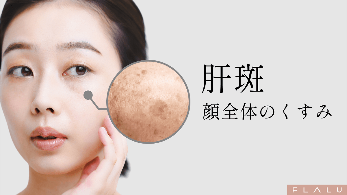 肝斑