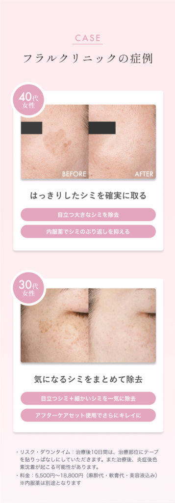 シミ取りレーザーの症例写真