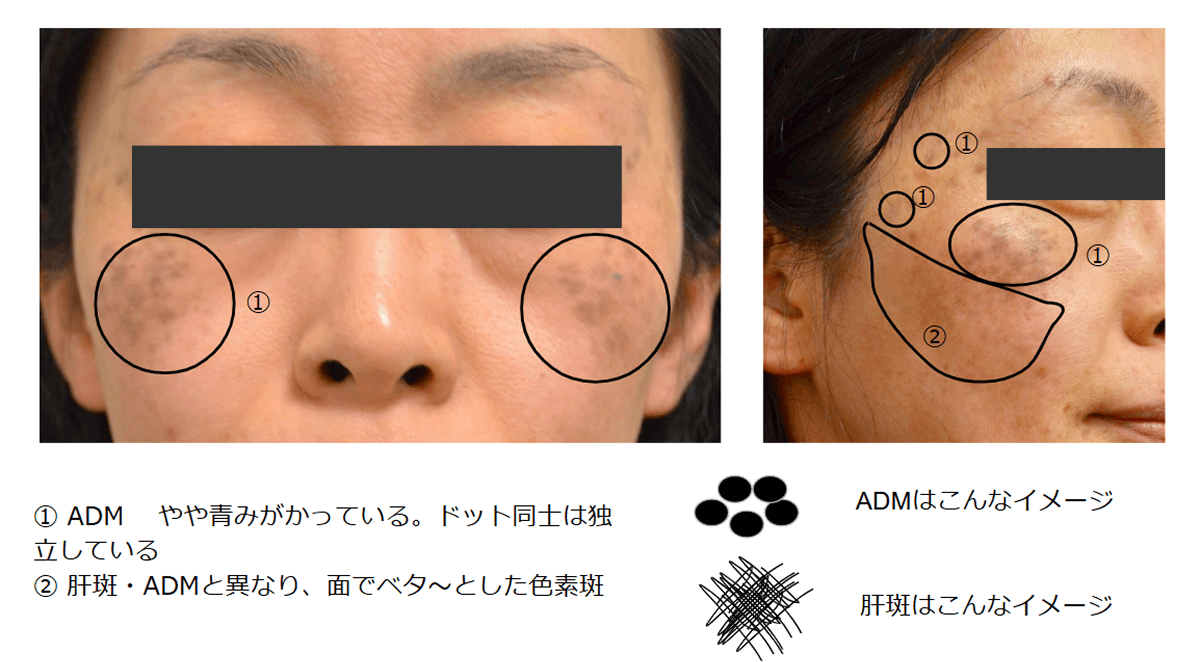肝斑・ADM症例_解説