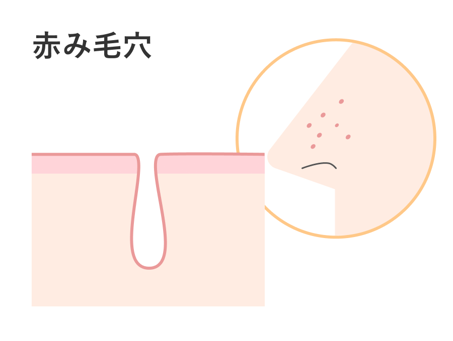 毛穴_赤み_250405