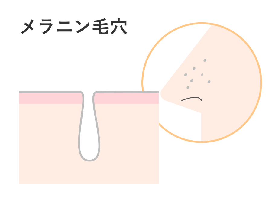 毛穴_メラニン_250405
