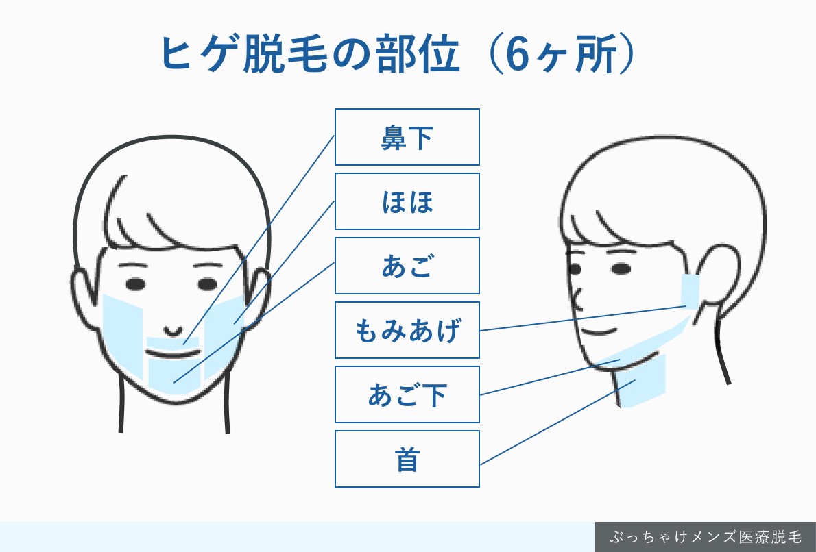 ヒゲ脱毛の照射範囲