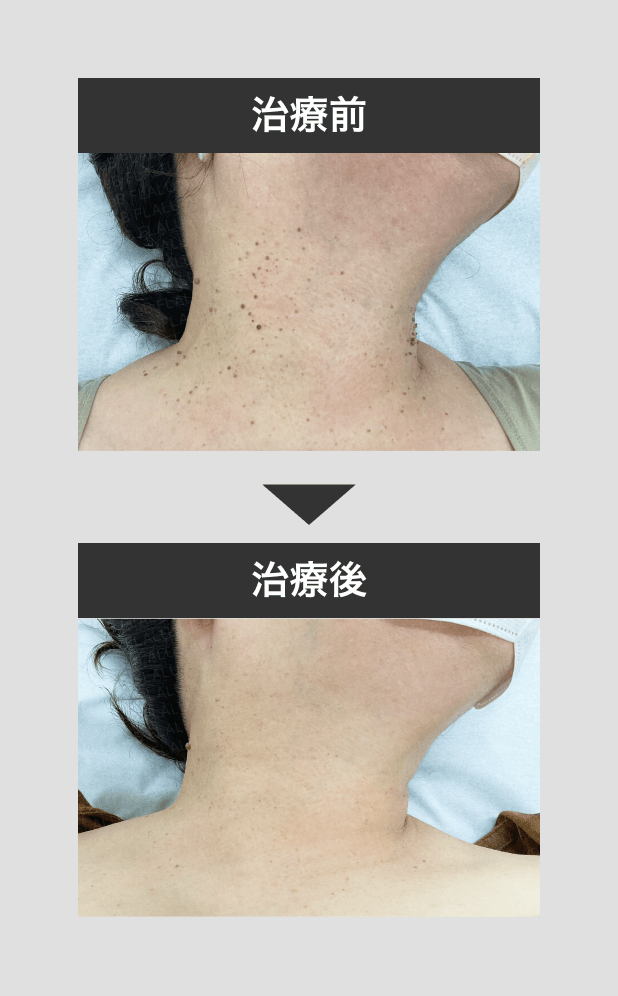 mikoメソッド1_mask_250424