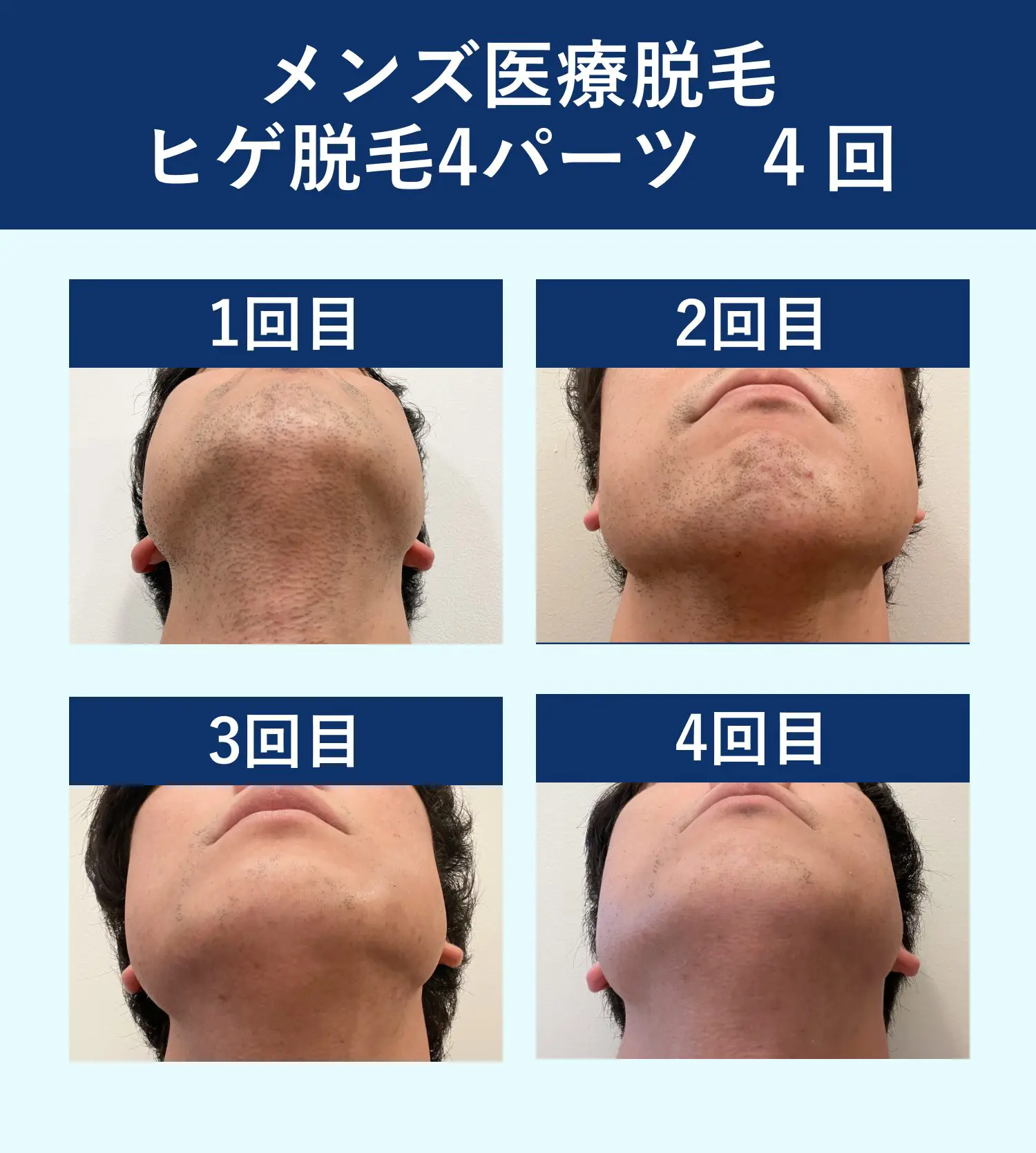 ヒゲ脱毛の回数例