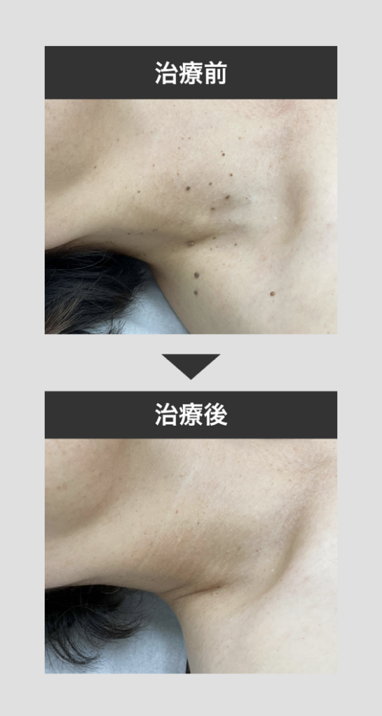 mikoメソッド症例