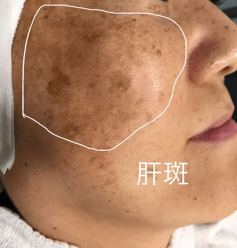 肝斑症例