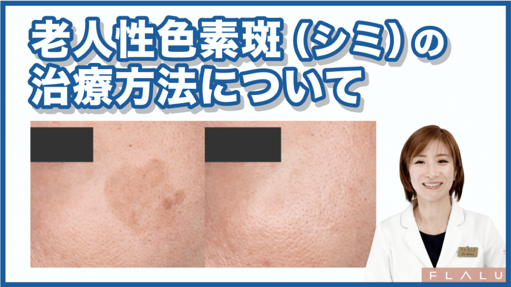 老人性色素斑(シミ)の治療方法について_MV