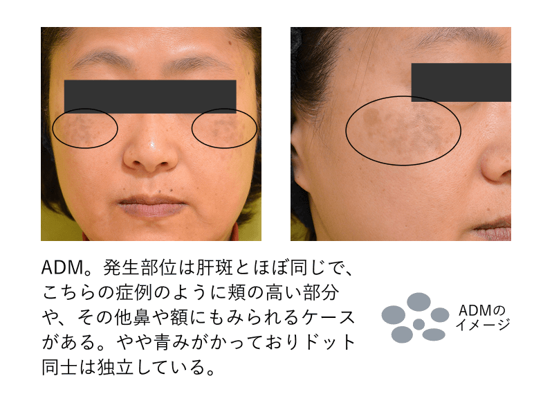 ADMの症例
