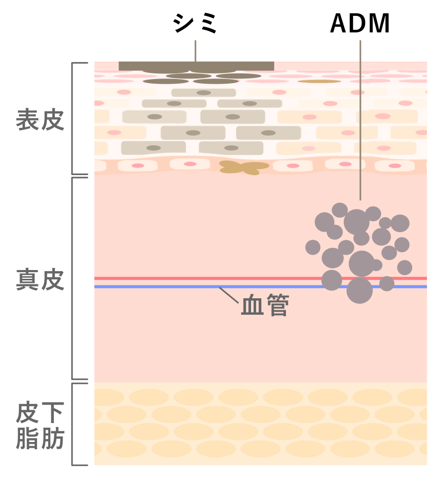image7 シミとADMの違いを示した図解