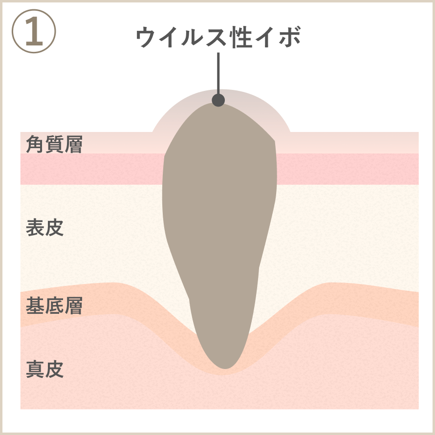 ウイルス性イボ_イボコロリ_1