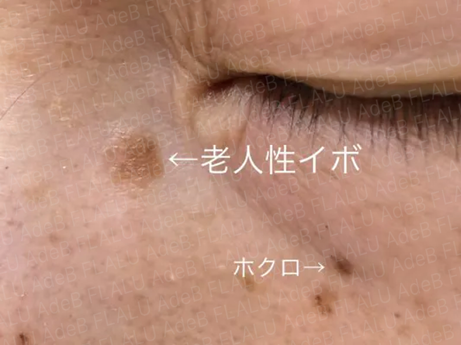 目元近くの老人性イボとほくろの症例写真