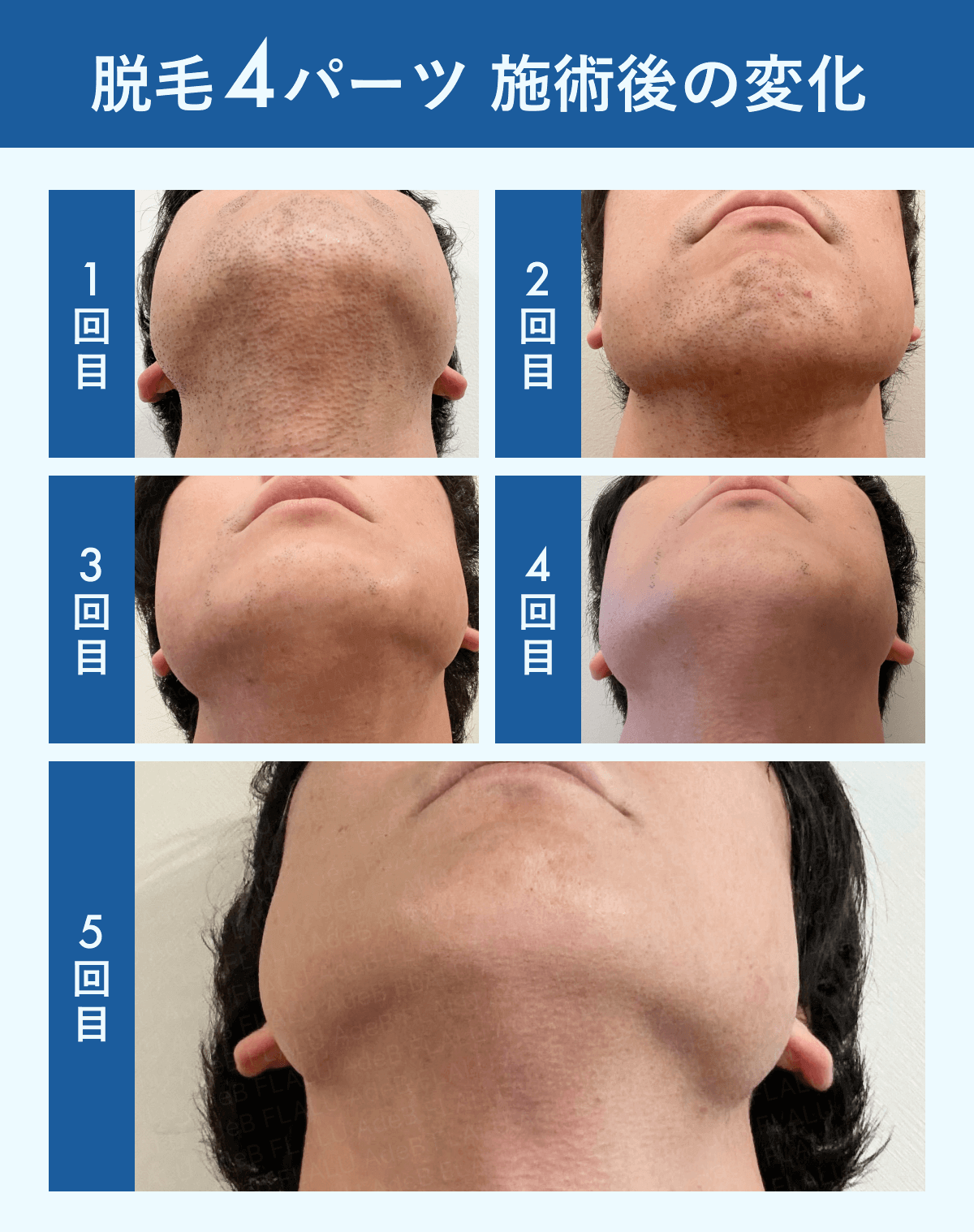 編集部が行ったヒゲ脱毛の変化イメージ