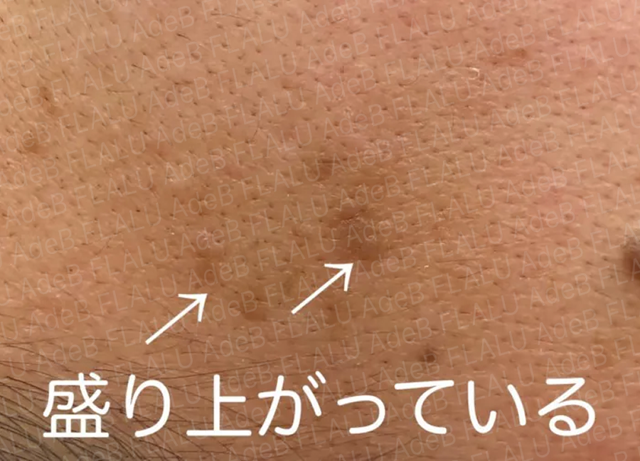 頬にある脂漏性角化症の症例写真
