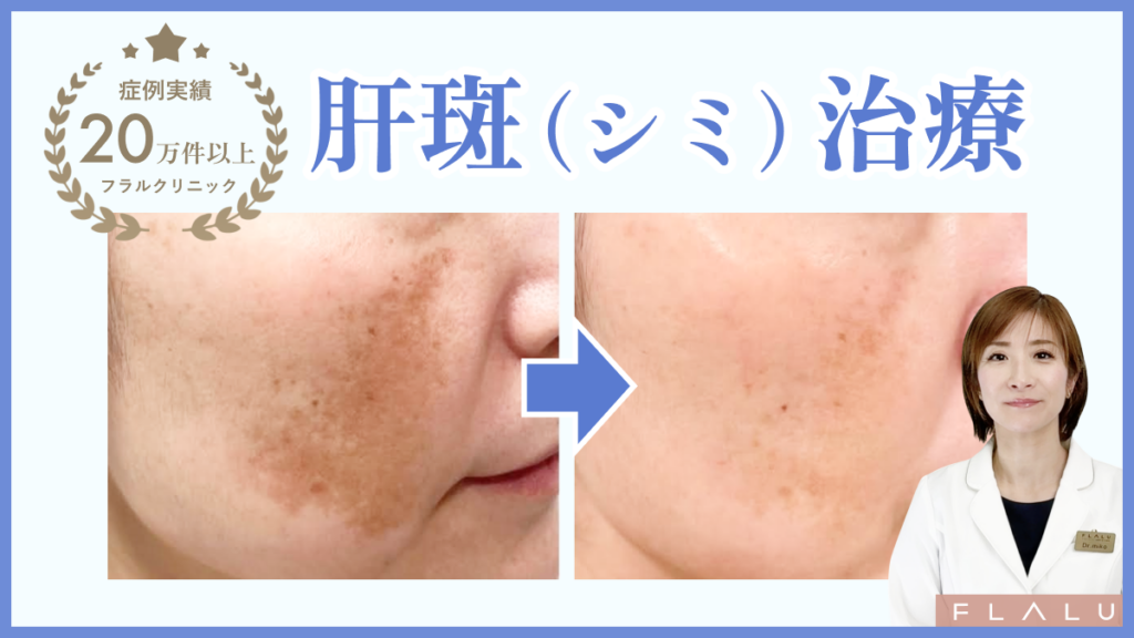皮膚科医による肝斑シミ治療の施術前後比較症例写真