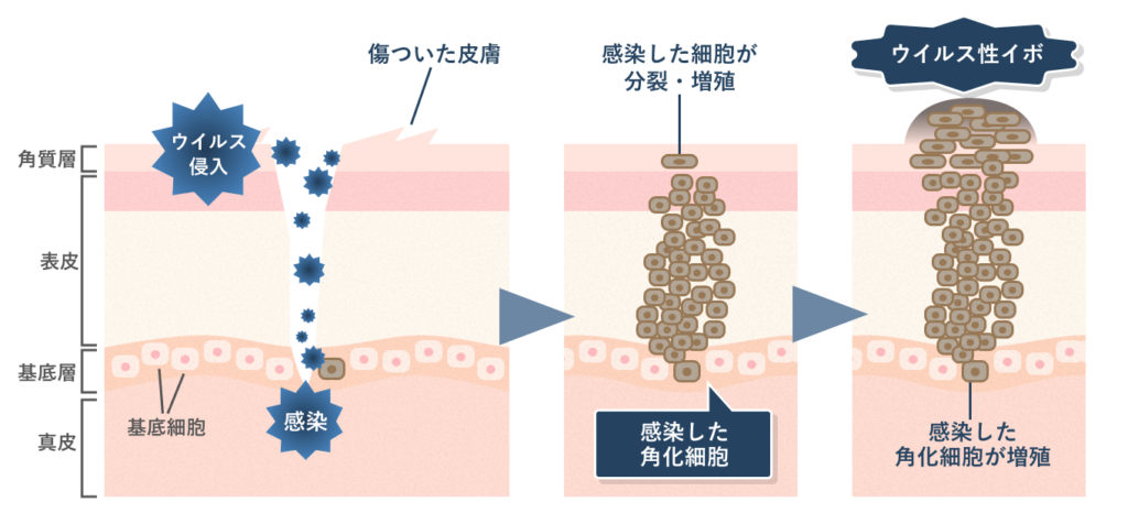 尋常性疣贅ができるまでの仕組みの画像