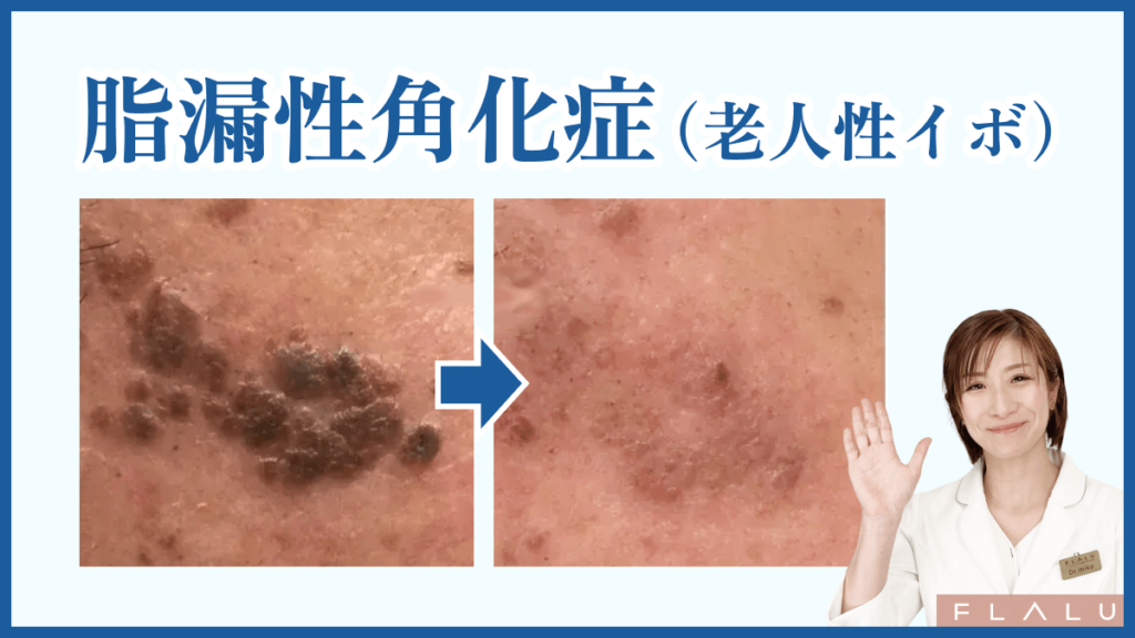 脂漏性角化症(老人性イボ)の取り方。症例写真を載せている写真