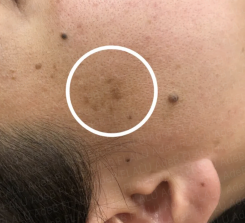 脂漏性角化症（老人性イボ）と見分けがつきにくいホクロ