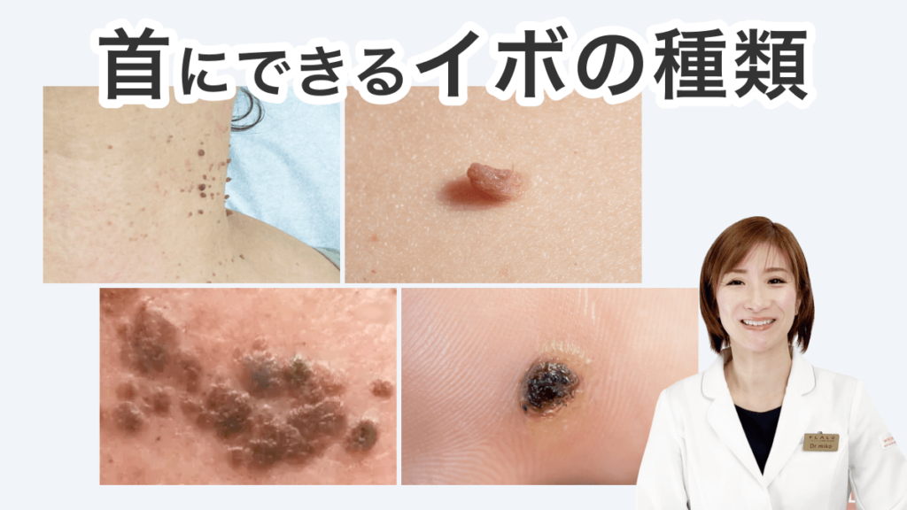首にできるイボの種類_MV