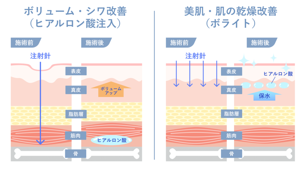 ボライト_ヒアルロン酸注入との違い_1_250614
