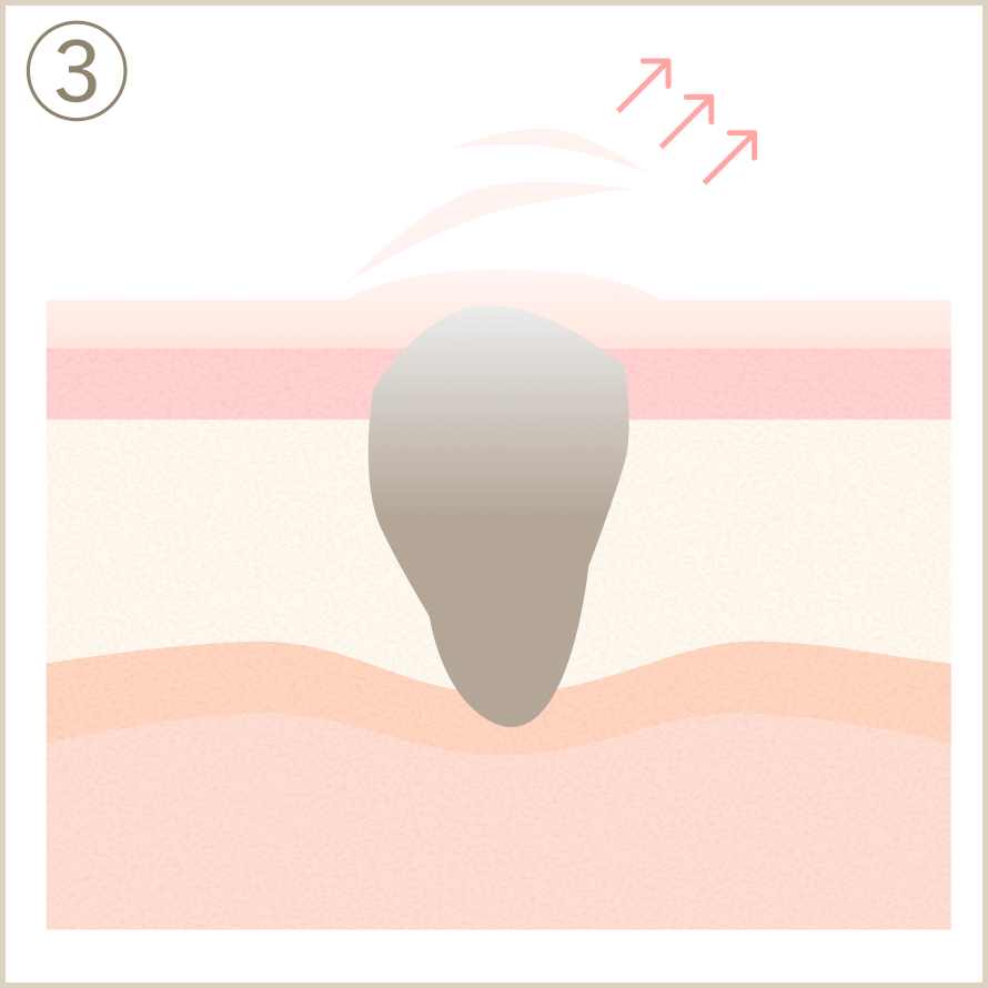 ウイルス性イボ_イボコロリ_3