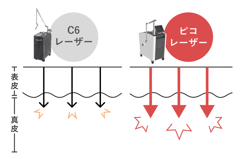 レーザーの違い