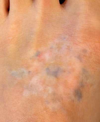 タトゥー除去経過