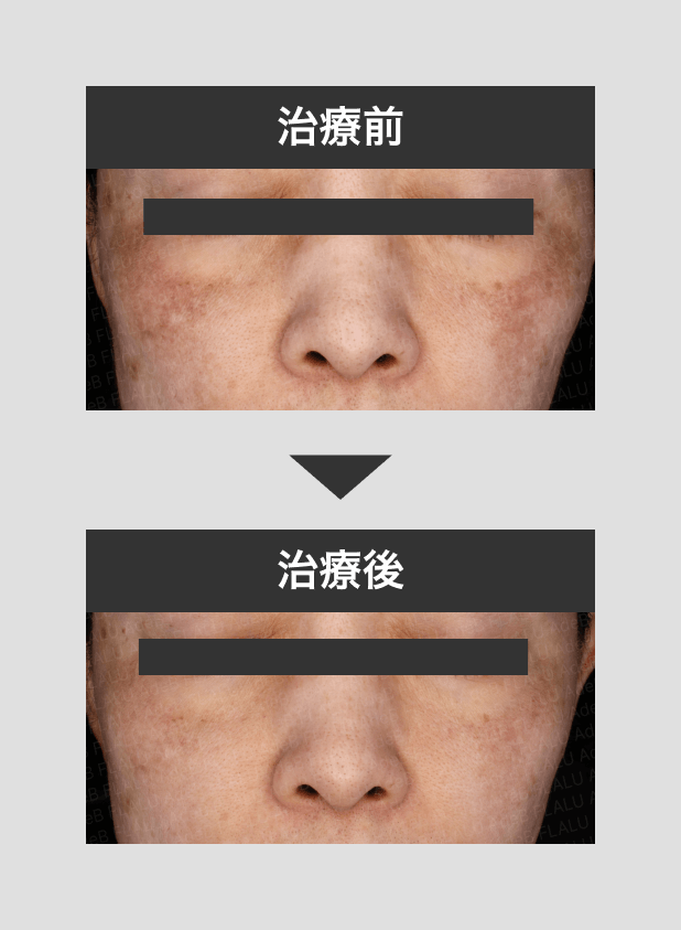 レアセラム＋トランサミン2_mask_250721