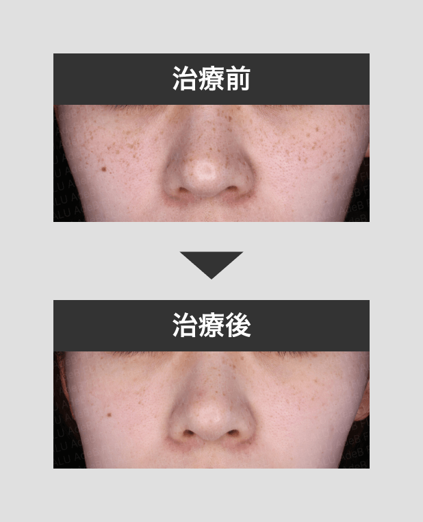 そばかすシャワー2回施術_mask_250721