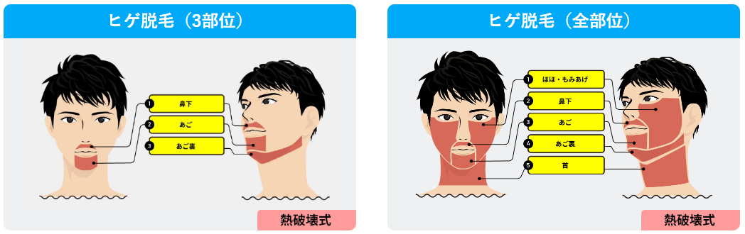 メンズリゼのヒゲ脱毛プラン料金