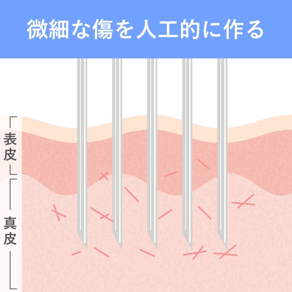 ダーマペン_図解1_250725