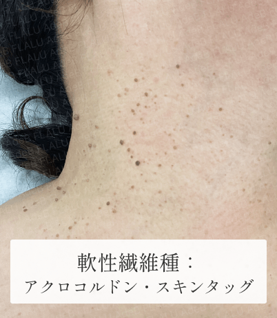 2_軟性繊維種_顔イボができる原因は?皮膚科で顔のイボ取り・除去