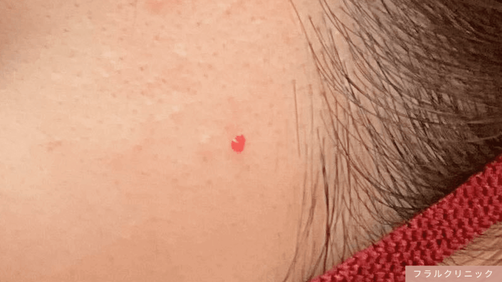 6_老人性血管腫_顔イボができる原因は?皮膚科で顔のイボ取り・除去