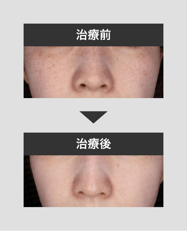 そばかすシャワー2_回施術mask_250721