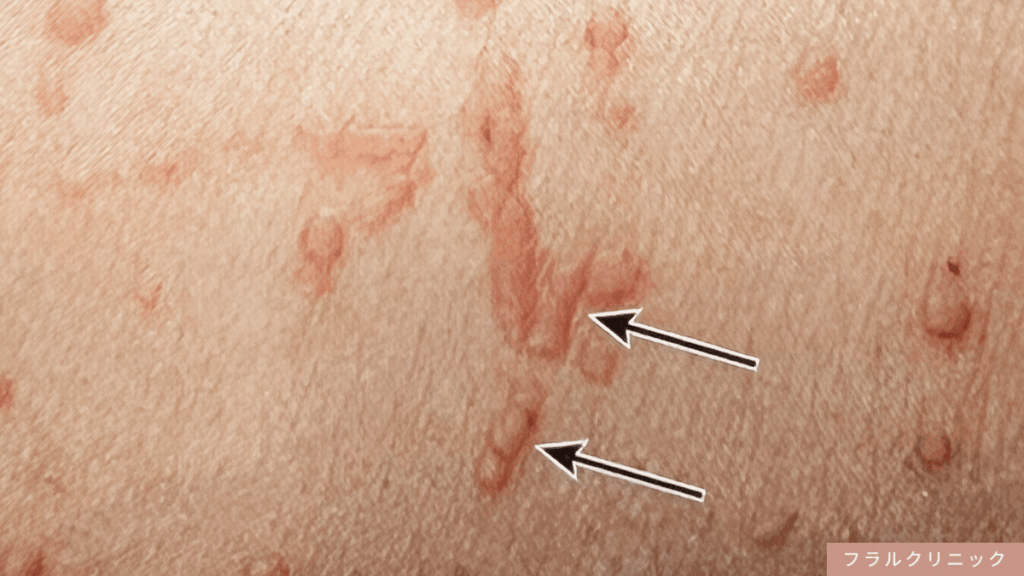 4_青年性扁平疣贅_顔イボができる原因は?皮膚科で顔のイボ取り・除去